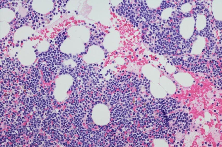 Mikrographie des Myelomneoplasmas