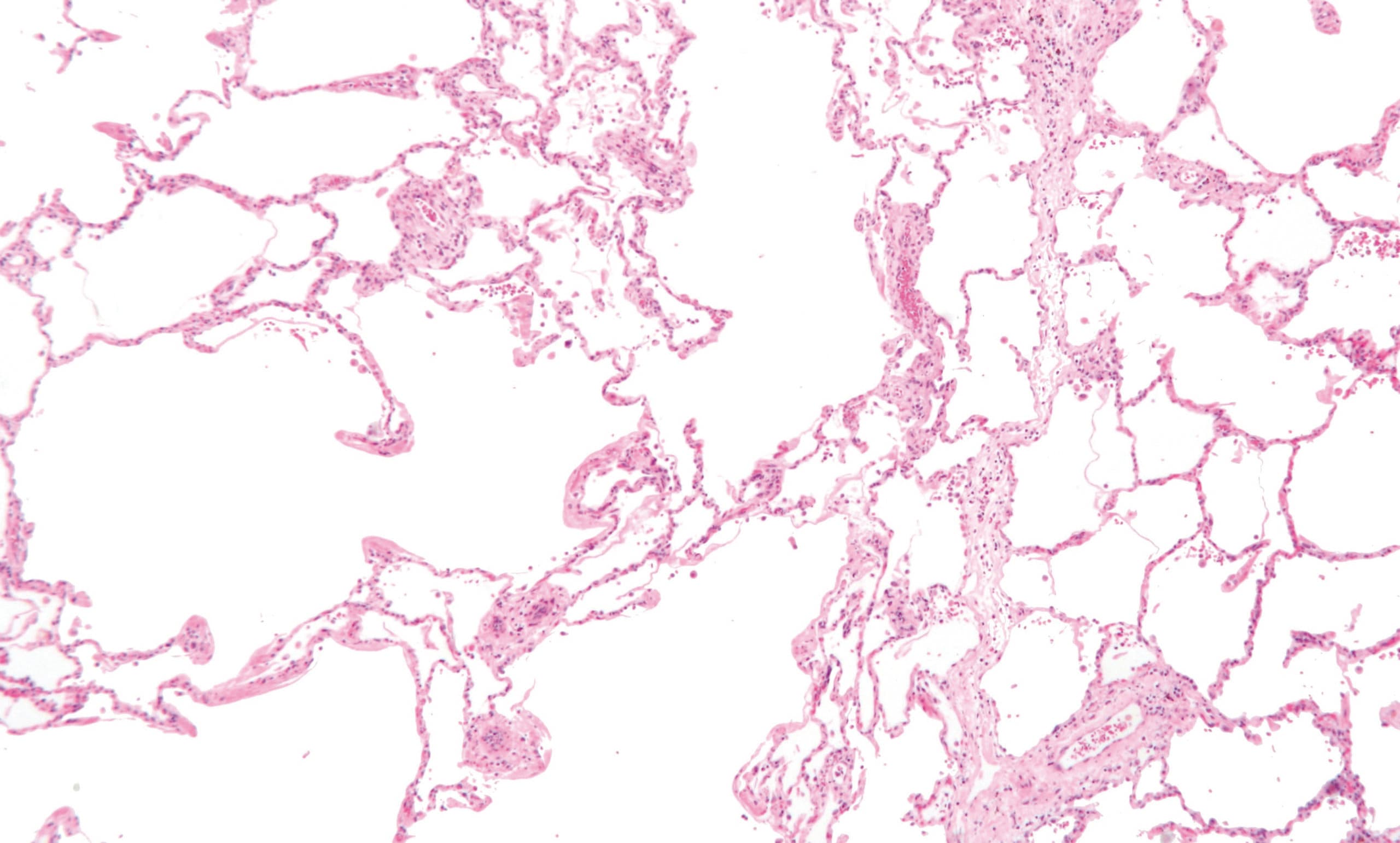 Emphysema_low_mag