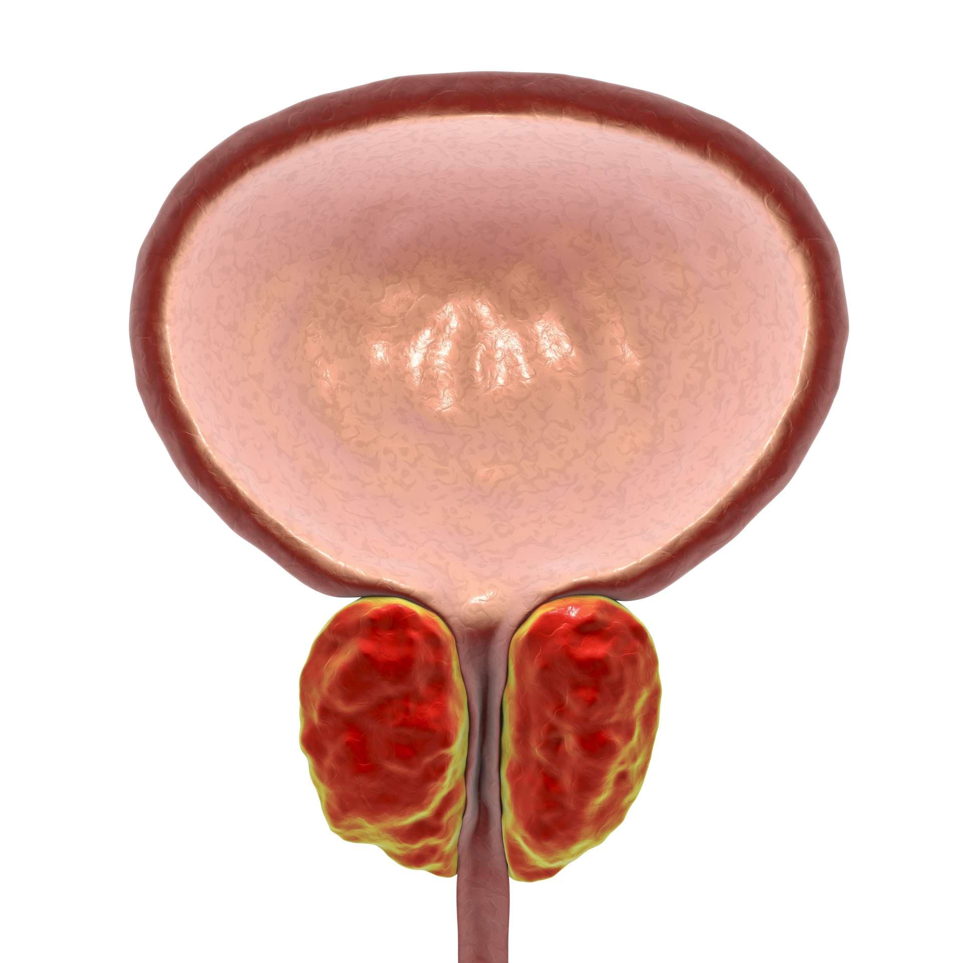 Gutartige Prostatahyperplasie, 3D-Darstellung mit vergrößerter Prostata