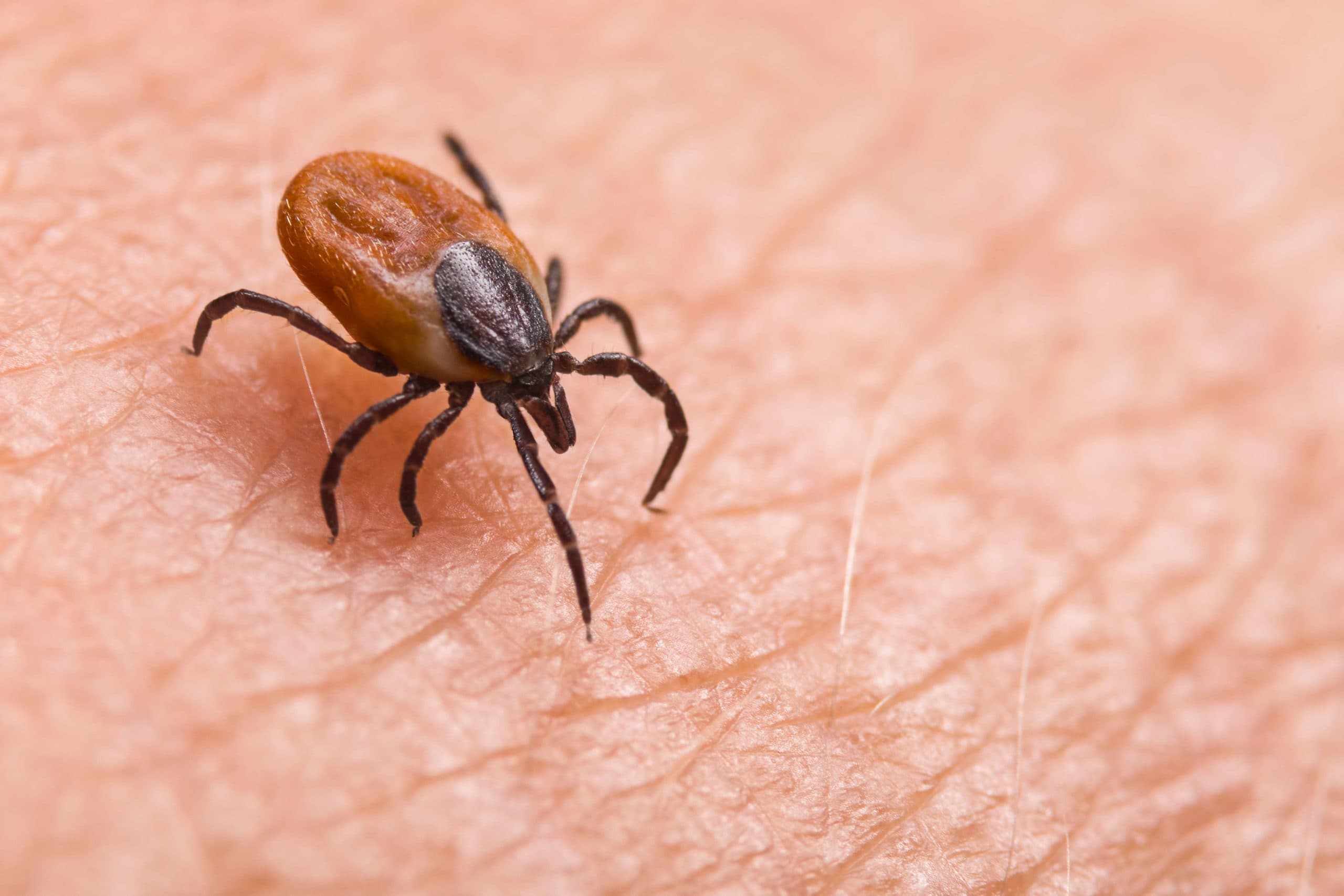Infizierte weibliche Hirsche ticken auf haariger menschlicher Haut. Ixodes ricinus. Gefährliches Milbendetail. Acarus. Infektiöse Borreliose