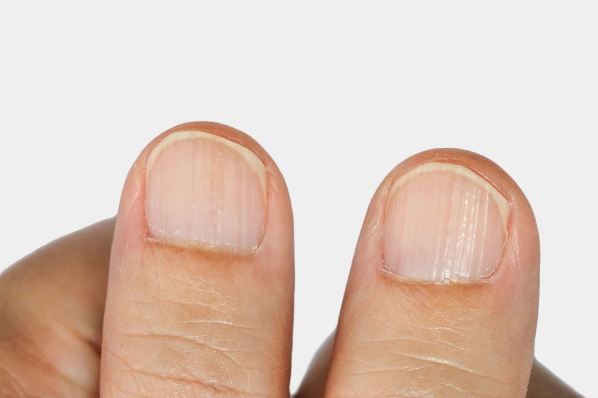 Vertical ridges on the fingernails symptoms deficiency  vitamins and minerals