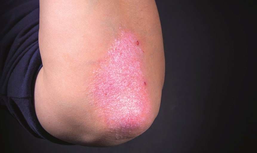 Psoriasis an den Ellbogen. Schwarzer Hintergrund