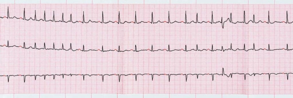 Notfallkardiologie. EKG mit supraventrikulären Extrasystolen und kurzen Anfällen von Vorhofflimmern