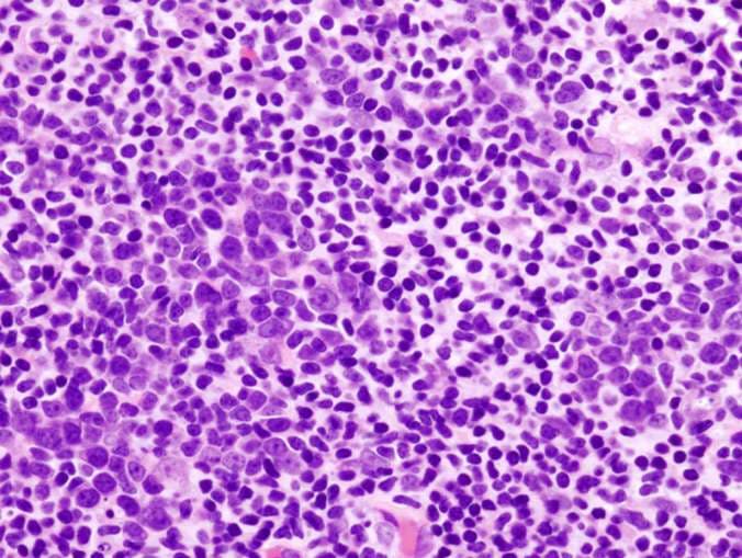 Mikroskopaufnahme B Zell Lymphom