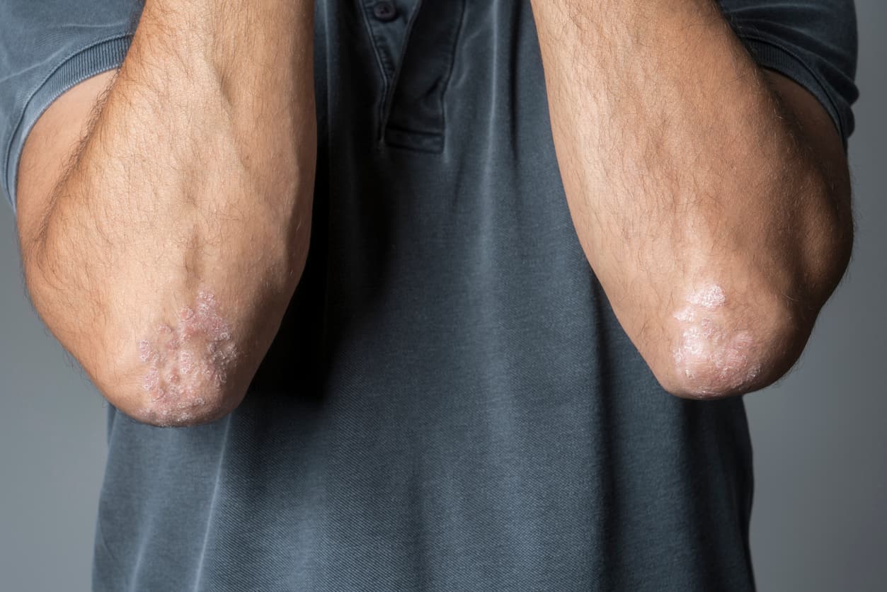 Mann mit Psoriasis am Ellenbogen