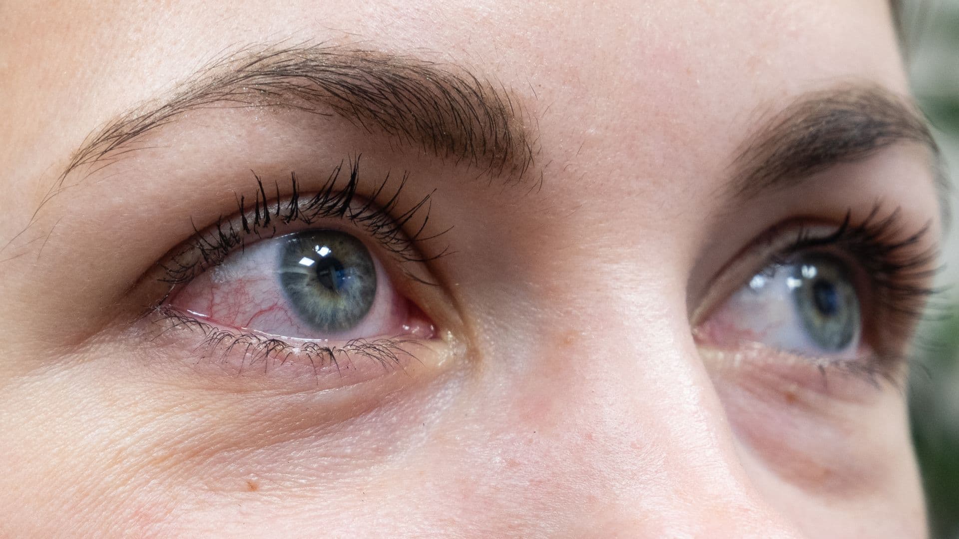 Gerötete Augen bei einer Frau