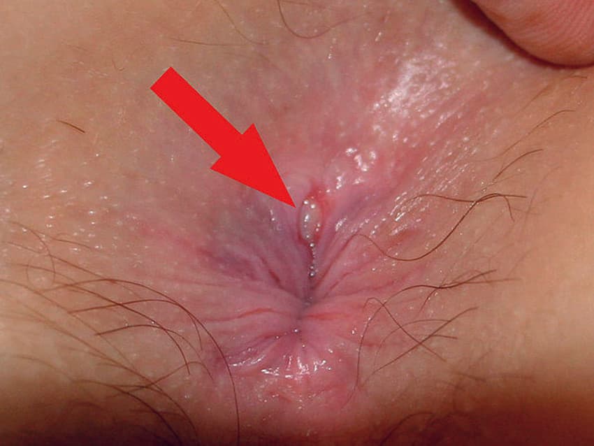 Analfissur