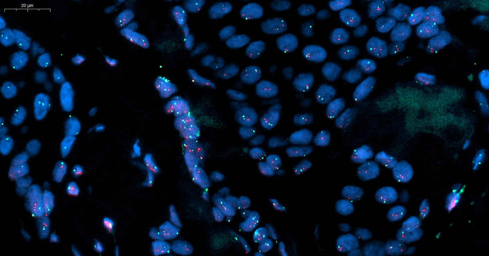 Fluoreszenz-In-Situ-Hybridisierung auf HER2