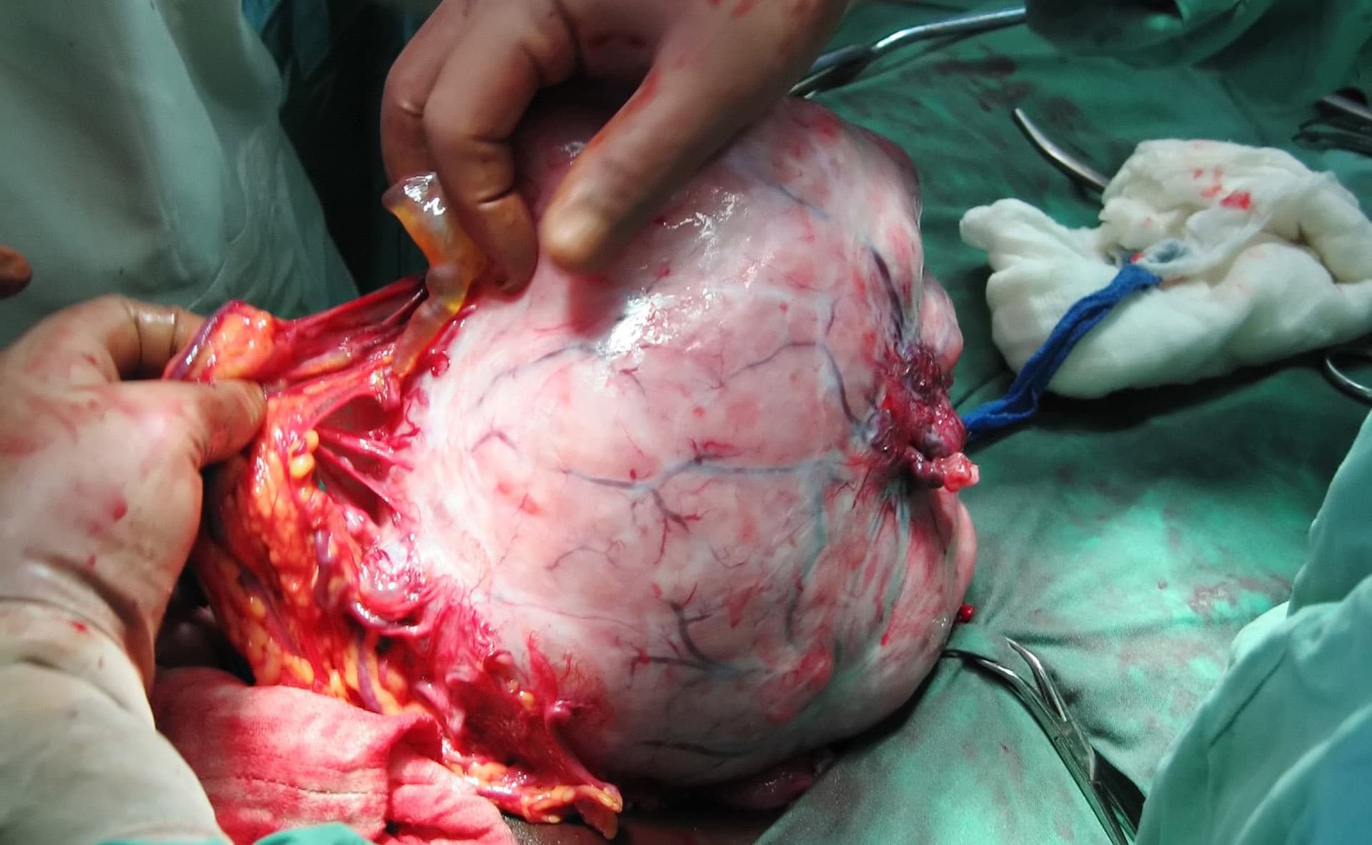 Ein grosser Eierstocktumor wird entfernt
