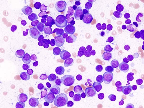 Ausstrich eines Patienten mit Multiplen Myelom