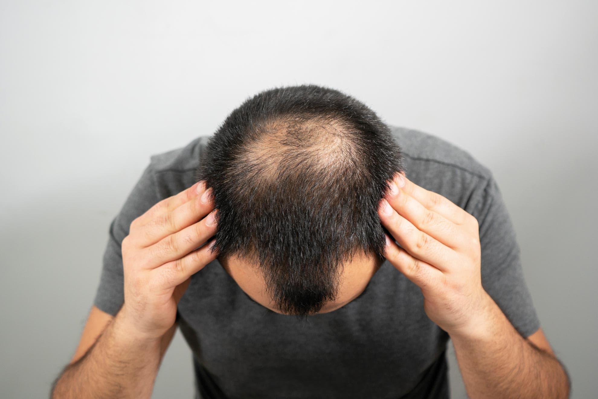 Mann mit Haarverlust beim Kopf