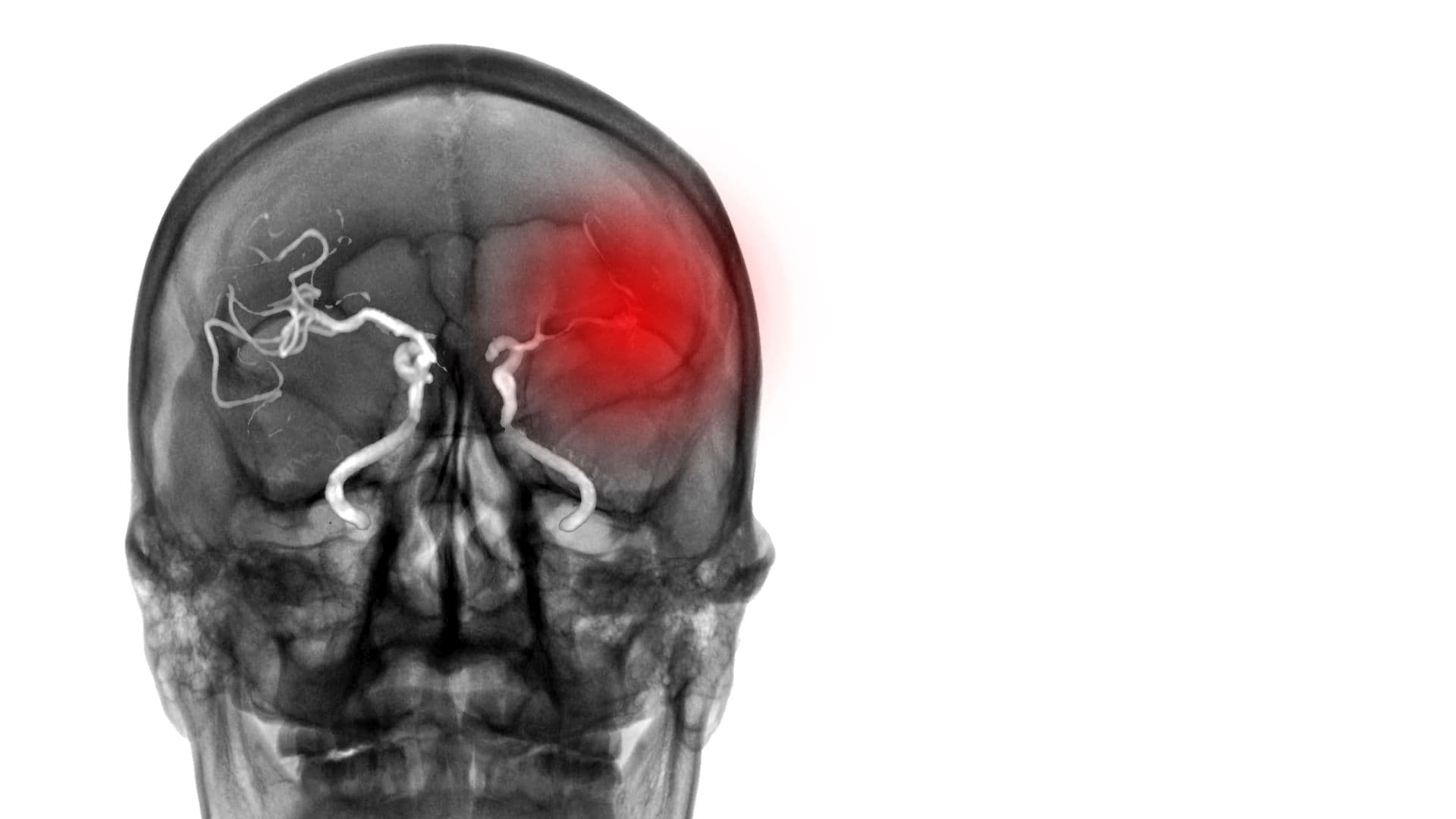 Die endovaskuläre Therapie ist auch bei grossen ischämischen Schlaganfällen nützlich. Leider ist sie auch mit mehr Blutungen verbunden, die aber zumeist nicht relevant sind.