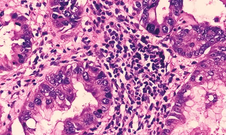 Mikroskopische Aufnahme einer Kernbiopsie der Prostata, die ein Adenokarzinom zeigt.
