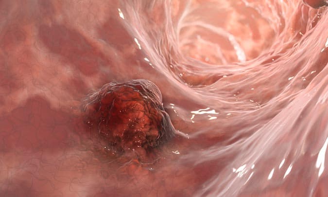 Colorectal cancer, intestinal carcinoma, bowel neoplasia, 3D illustration showing malignant tumor in intestine