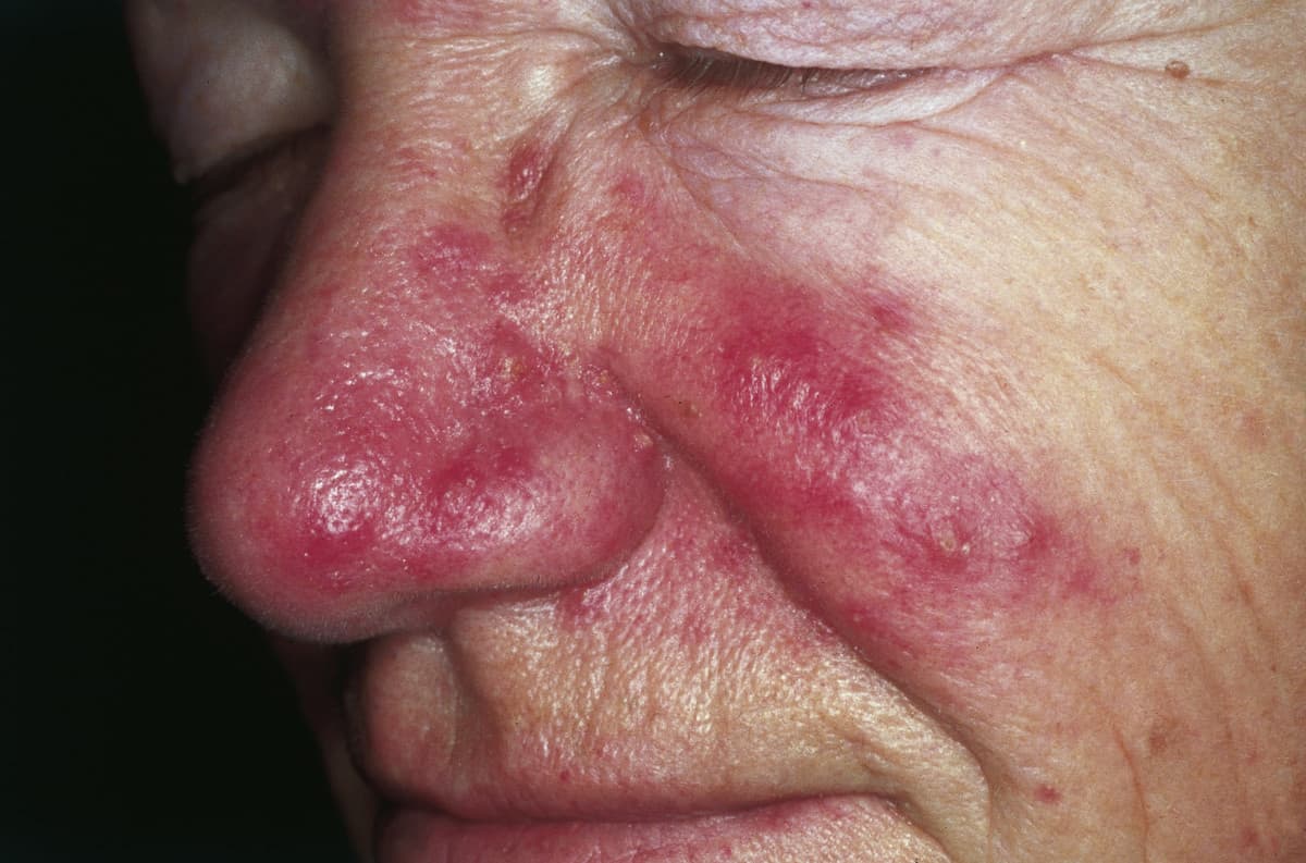 Rosacea kann in vier Subgruppen daherkommen.