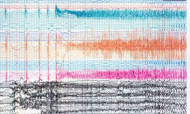 Aufzeichnung von Gehirnwellen während eines epileptischen Anfalls