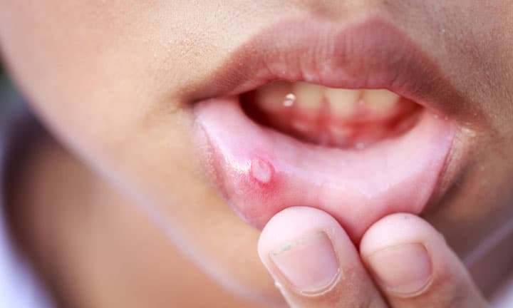 Close up Children with aphtha on lip