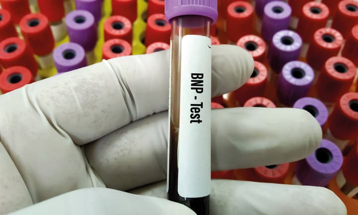 Nahaufnahme einer Hand mit medizinischem Handschuh, die ein mit BNP-Test beschriftetes Blutröhrchen hält