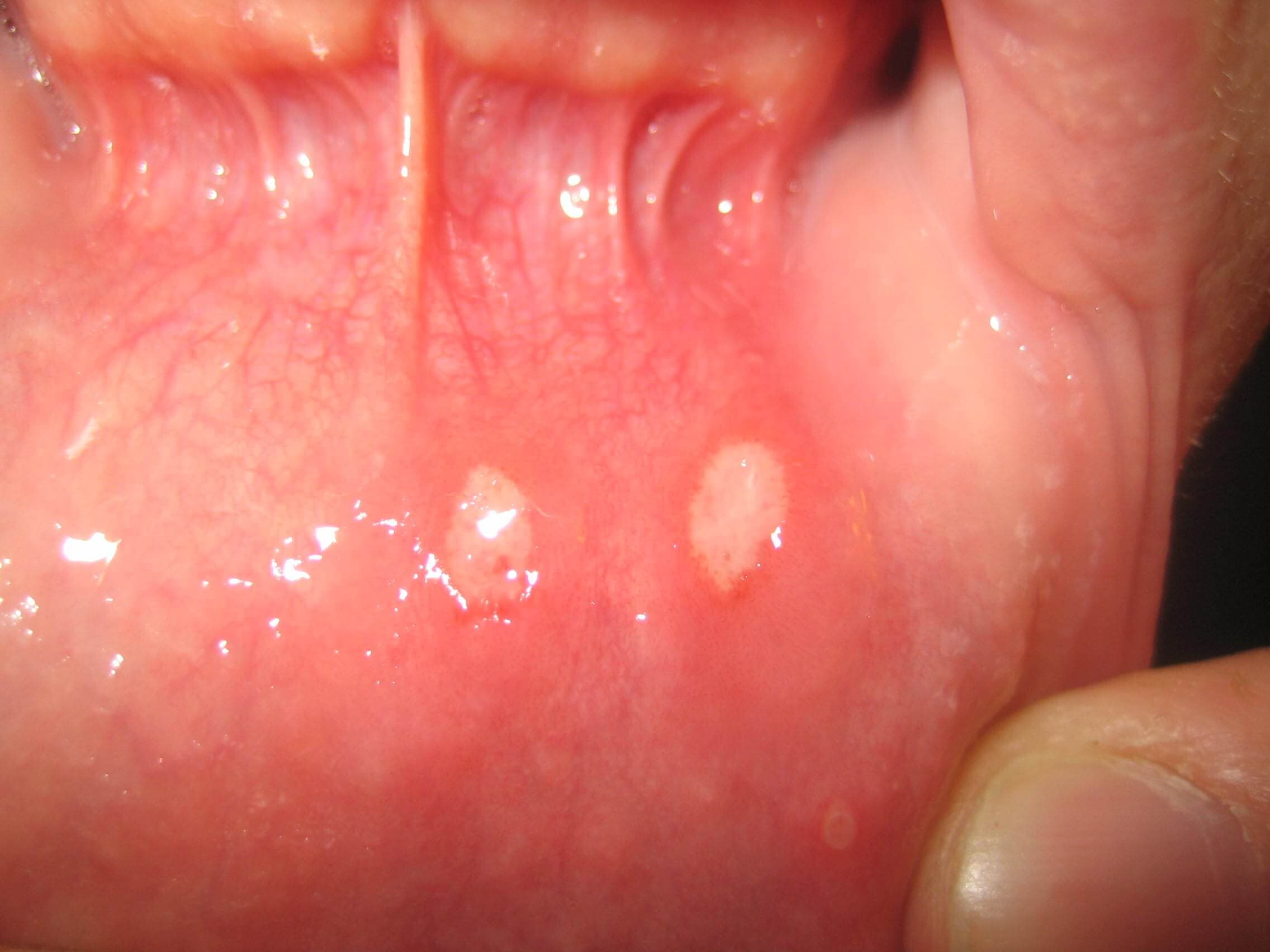 Aphthen sind Teil des Erscheinungsbildes des PFAPA-Syndroms