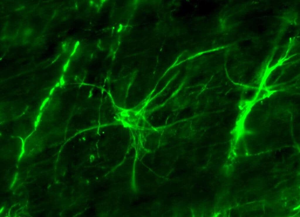 In gesunden Astrozyten liegt GFAP normal zytoplasmatisch vor.