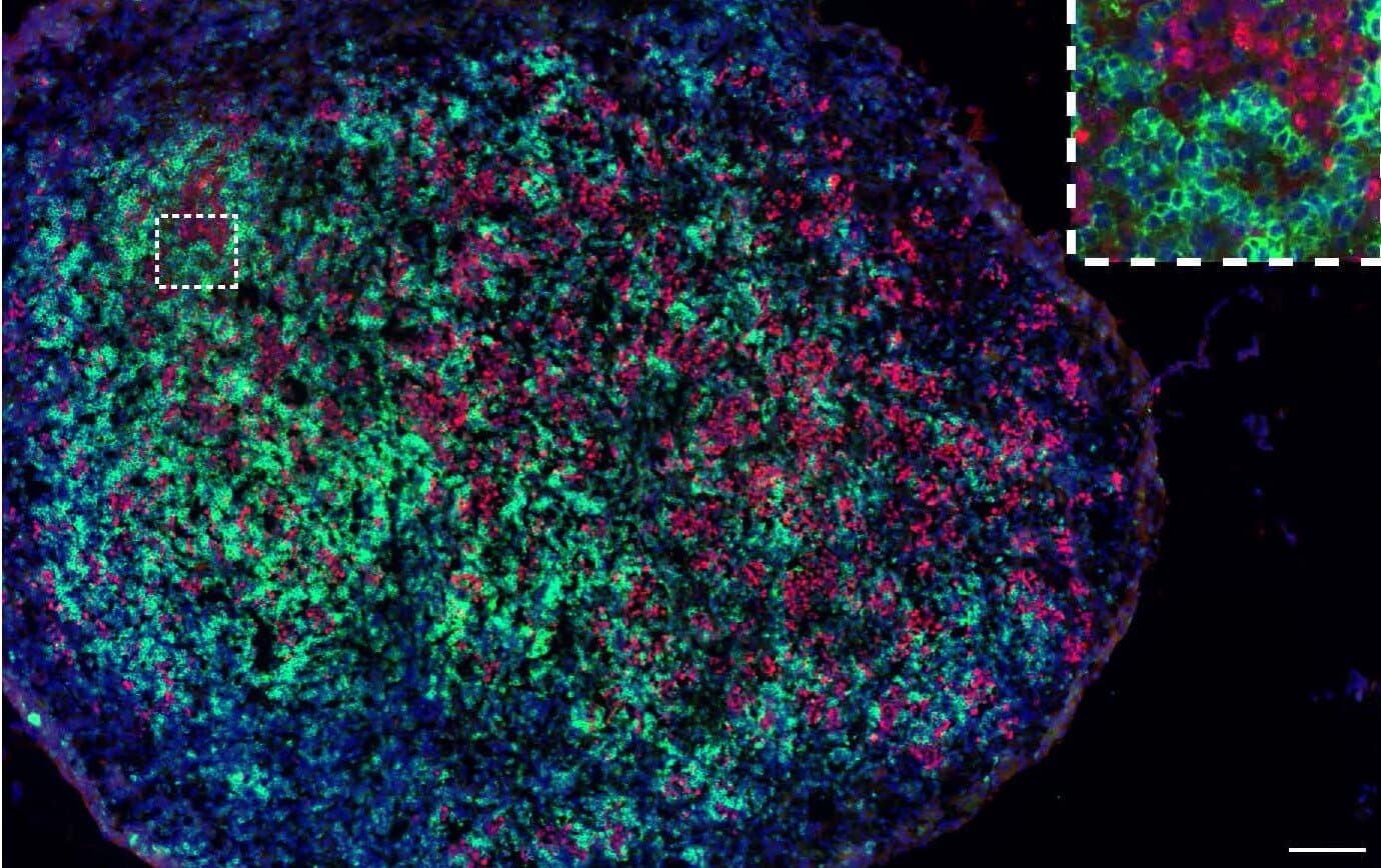 CD8-positive Zellen infiltrieren einen Tumor, der mit der Wirkstoffkombination aus PD1-IL2v und anti-PD-L1 behandelt wurde