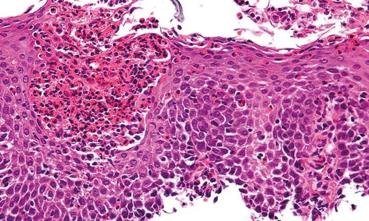 Mikroskopische Aufnahme einer Eosinophilic esophagitis
