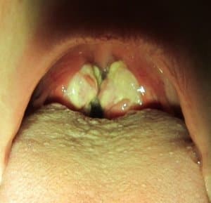 Mononukleose