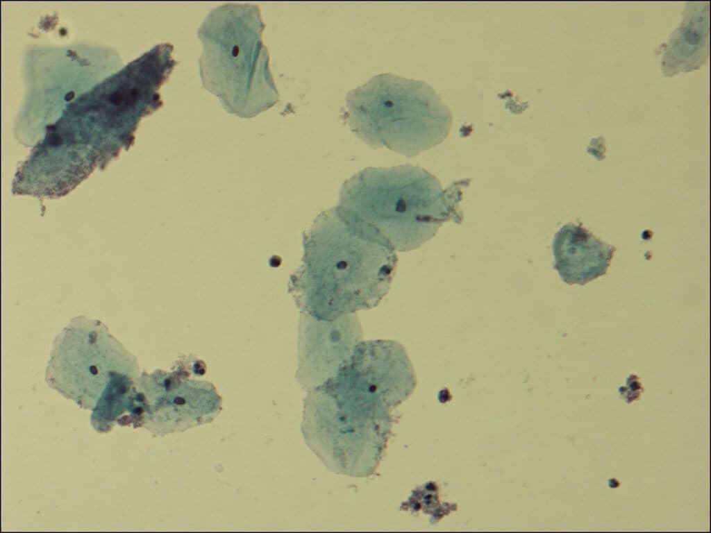 Die lichtmikroskopische Aufnahme eines Zervixabstrichs zeigt eine bakterielle Vaginose mit Gardnerella vaginalis, dem häufigsten Verursacher von Spätaborten.