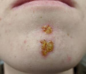 Aufgrund aufkeimender Resistenzen will der Griff zu Antibiotika beim Impetigo gut überlegt sein.