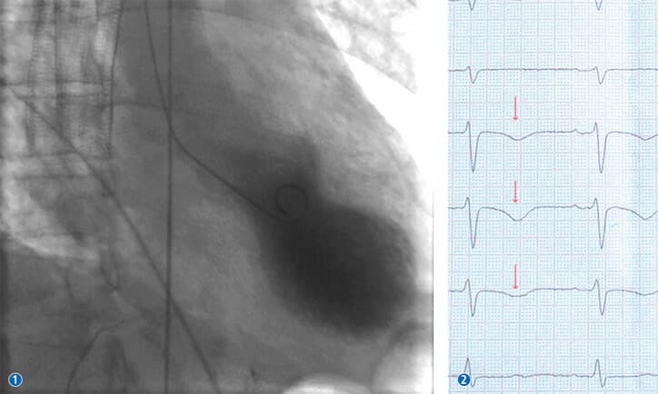 Ein Takotsubo-Syndrom lässt sich in der Ventrikulografie und am EKG erkennen.