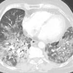 Pneumonitis auf Everolimus