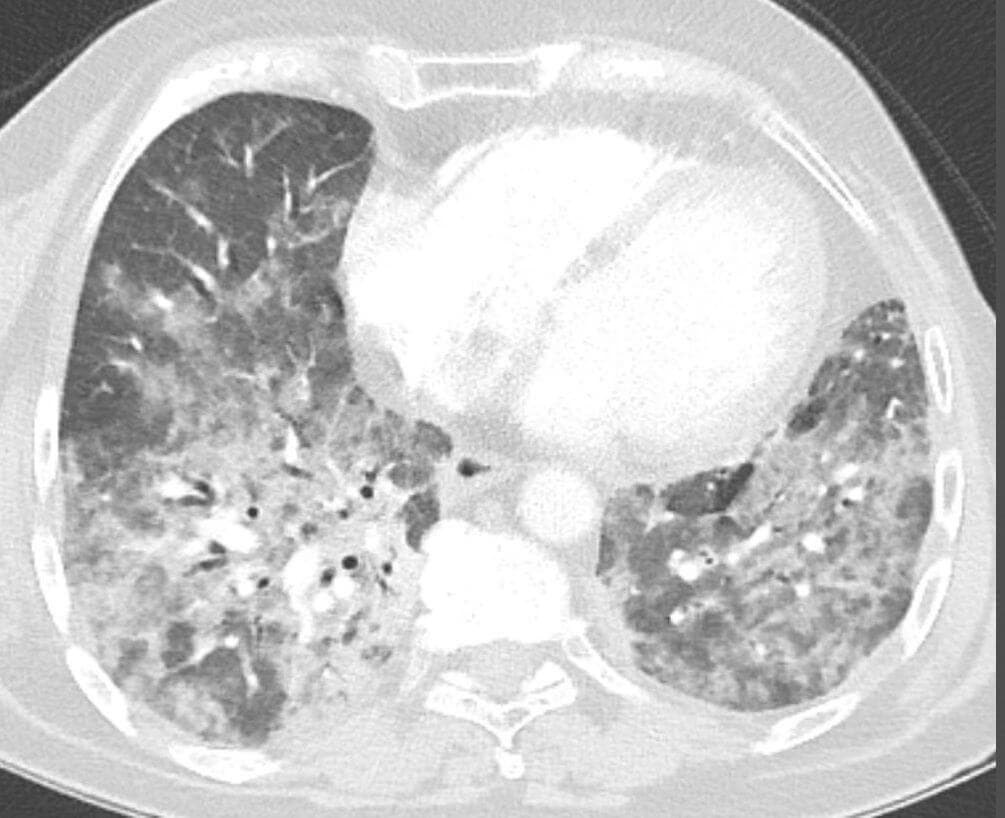 Pneumonitis auf Everolimus