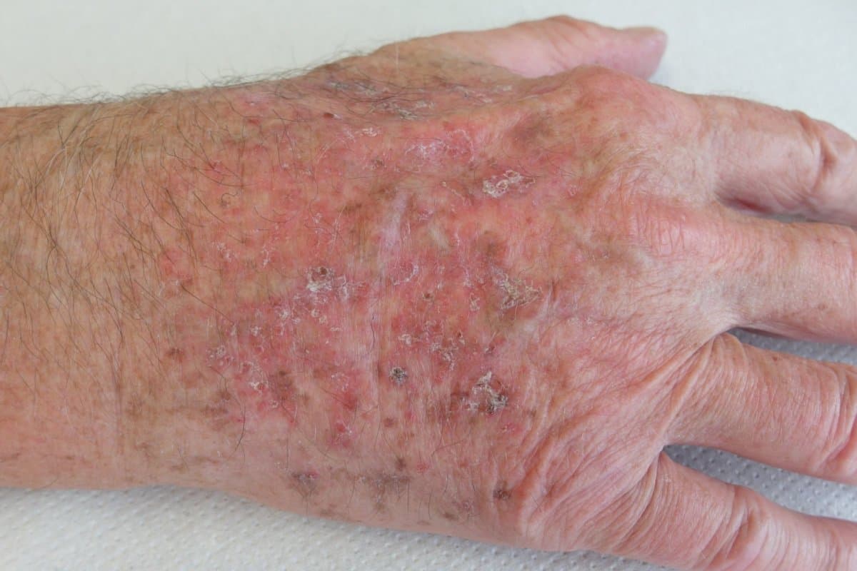 Aktinische Keratose am Handrücken