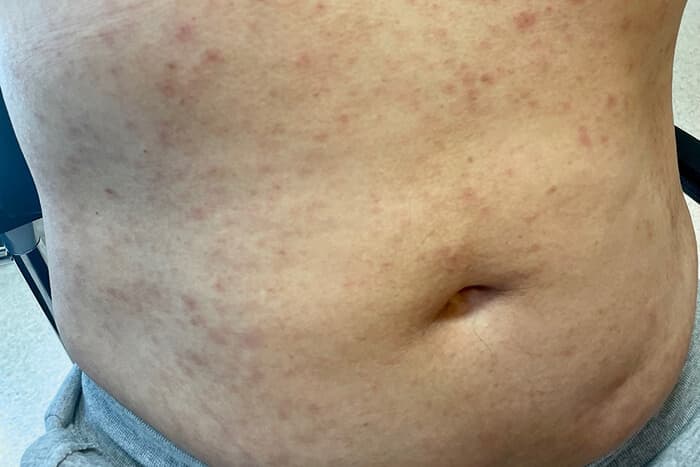 Fotografie eines männlichen Bauches mit makuloesem exanthem aufgrund Syphilis-Erkrankung.
