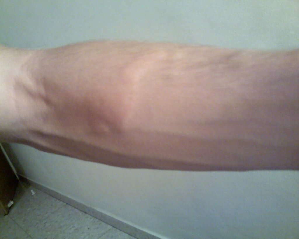 Urtikarielles Exanthem