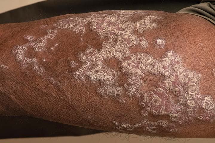 Arm mit Psoriasis
