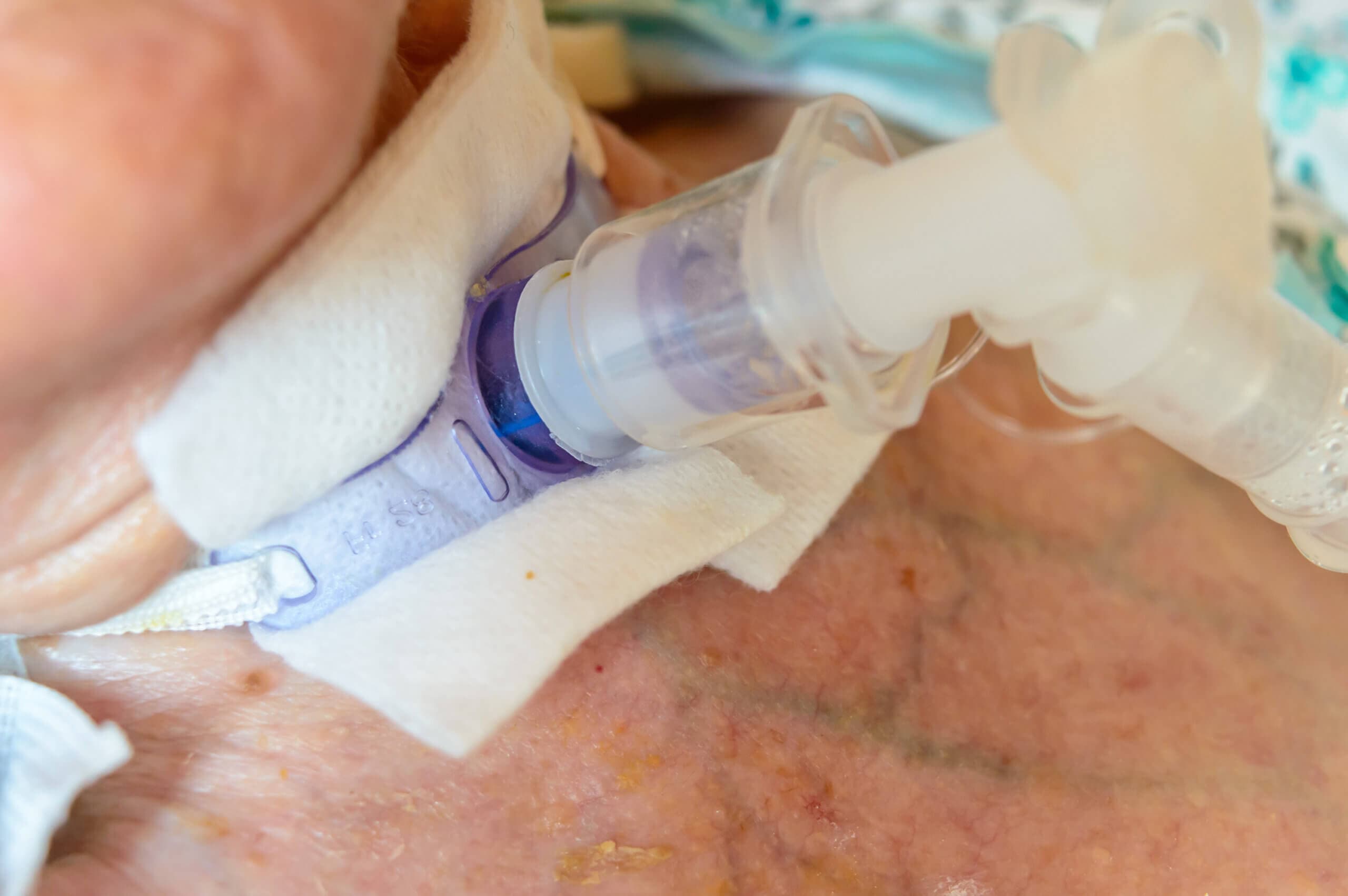 Nahaufnahme eines Trachealtubus oder Tracheostomie-Tubus.