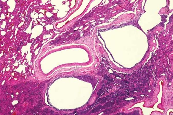 Fibrosierendes Lungengewebe