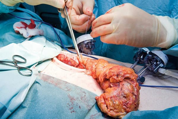 Beim Darmkrebs kann eine postoperative Liquid Biopsy die Therapiestrategie verbessern.