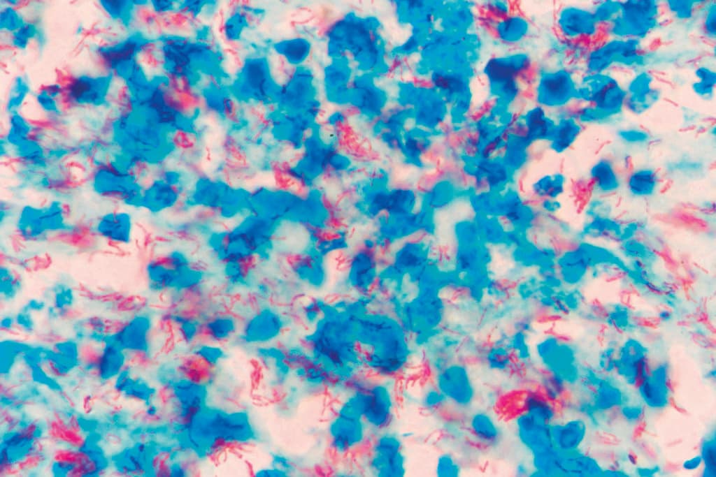 Mycobacterium tuberculosis undermicroscope