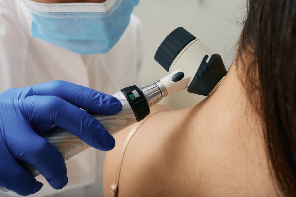 Muttermal-Dermatoskopie. Der Arzt untersucht das Muttermal des Patienten mit einem Dermatoskop zur Vorbeugung von Melanomen, Nahaufnahme.