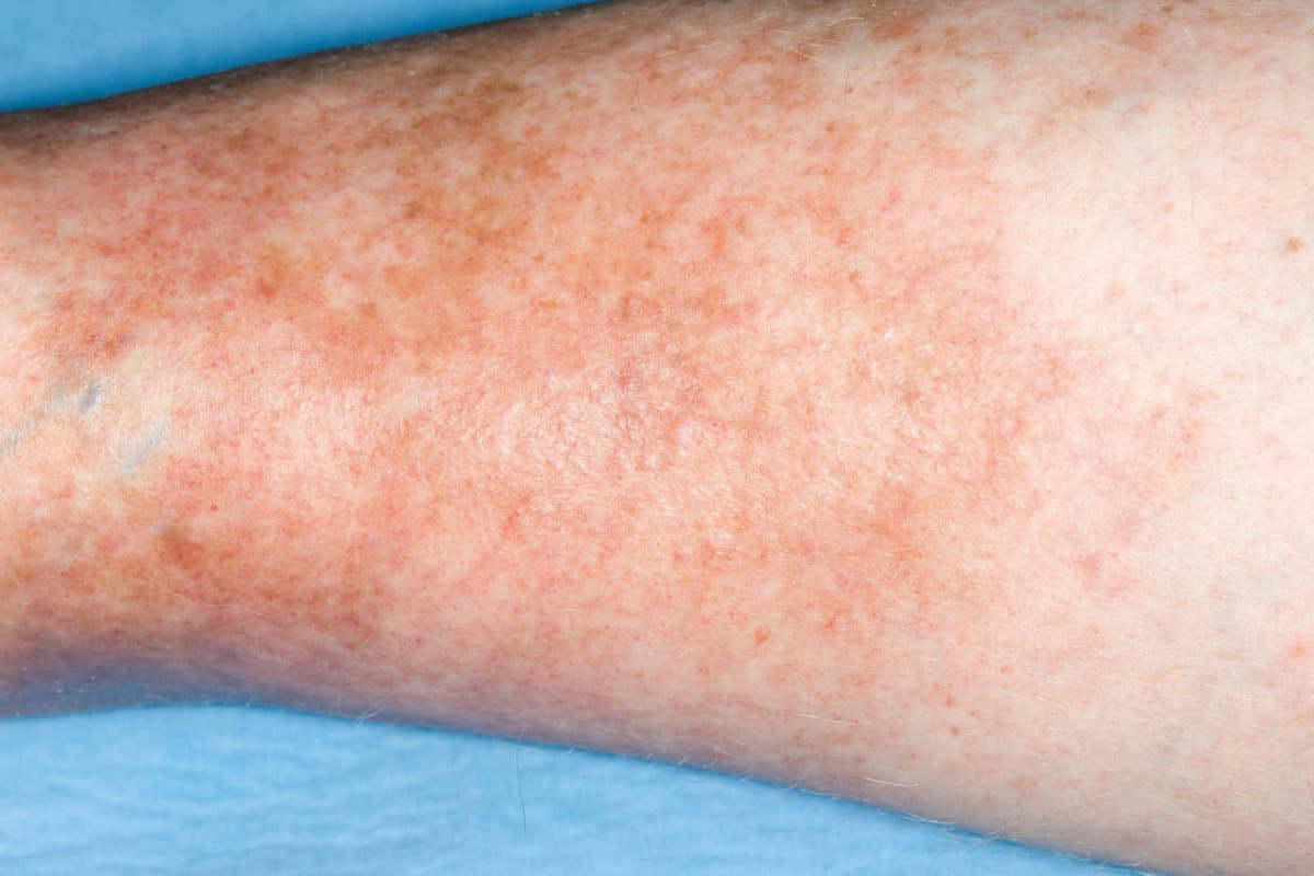 Varicose eczema