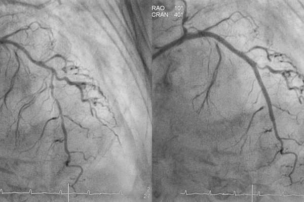 Koronararterie vor und nach Implantation eines Stents