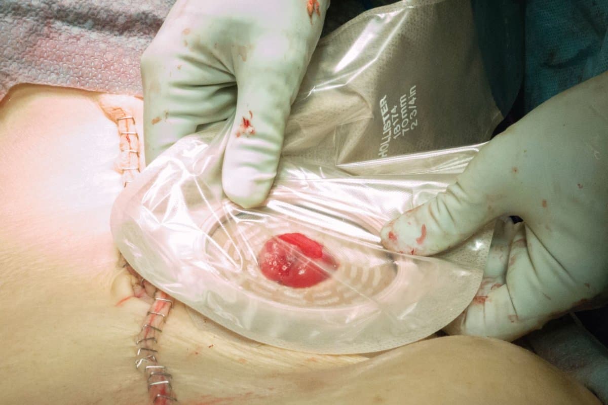 Der Zeitpunkt der Stoma-Rückverlegung hat keinen Einfluss auf die Komplettierung der adjuvanten Chemotherapie.