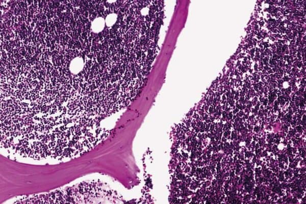 Chronische Lymphatische Leukämie