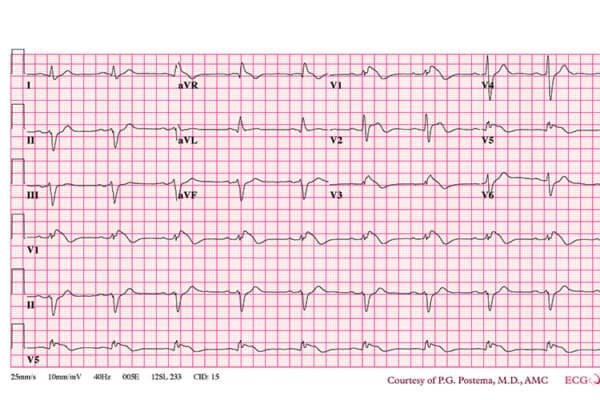 EKG Kardiogramm