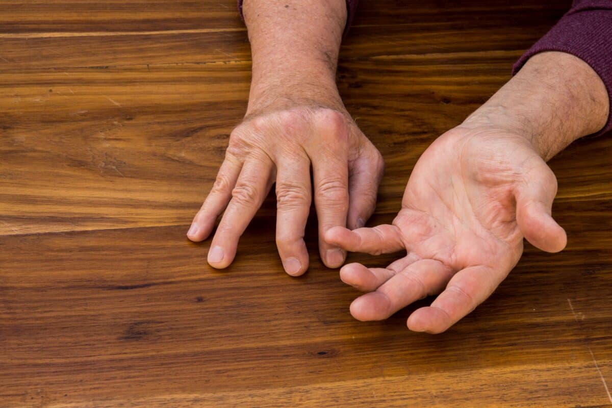Est-ce vraiment une arthrite psoriasique?