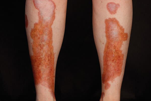 nécrobiose lipoïdique