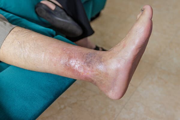 Ulcer