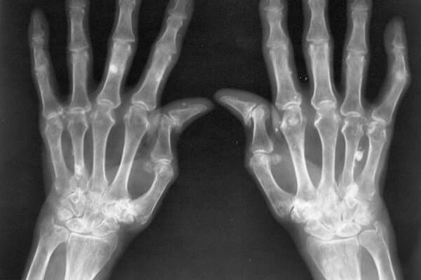 Image radiologique typique d’une polyarthrite rhumatoïde